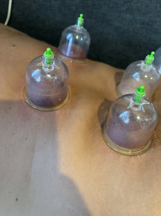 Ventuza / wet cupping